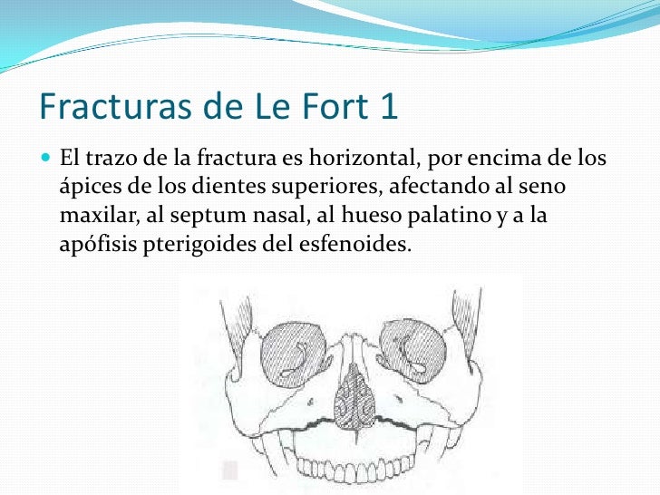 Trauma facial